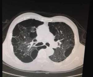 小伙体检发现右肺神秘消失 医生诊断：是右侧大量气胸