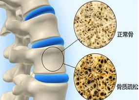 女性骨质疏松症状