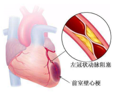 心梗心衰治疗用什么药好