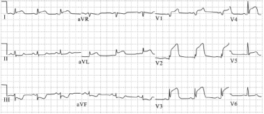 高侧壁心肌梗死心电图表现怎么样